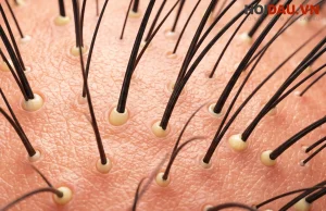 Hoạt chất Minoxidil có tác dụng gì